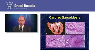 CV Grand Rounds – Cardiac Sarcoidosis