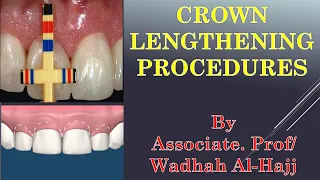 37-Periodontal surgery-6(Crown lengthening procedures )Wadhah Periodontology lectures.د/ وضاح الحاج