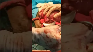 || Cesarean delivery / c-section ,Caesarean section birth - a new human enters the world ||