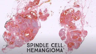 Spindle cell hemangioma (pathology dermpath dermatology dermatopathology)