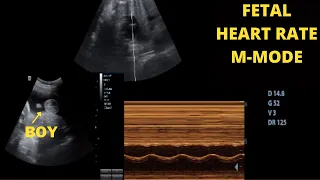 Baby boy's Beautiful Heartbeat at 36 weeks captured on Ultrasound M - Mode