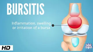 Bursitis, Causes, Signs and Symptoms, Diagnosis and Treatment.