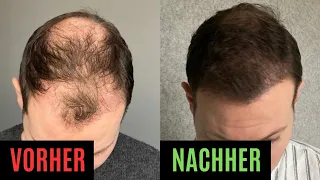 Haartransplantation Vorher/Nachher (Elithair Türkei)