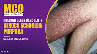 Rheumatology Vasculitis - Henoch Schonlein Purpura | Dr. Sandeep Sharma - PrepLadder NEET-SS