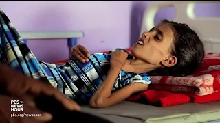 Yemen's spiraling hunger crisis is a man-made disaster