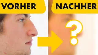 Geschlossene Nasen-OP VORHER / NACHER Ergebnis bei 24-jährigem YouTuber | Dr. Jungwirth