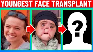 Plastic Surgeon Reacts to The Youngest Face Transplant! How'd She Do?