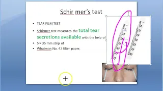 Ophthalmology 396 b Schirmer test Dry eye Tear Film test Paper Keratoconjunctivitis Sicca KCS