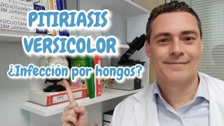 Dermatólogo explica la pitiriasis versicolor. Manchas por hongos en la piel