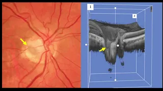 Inner Retinal Fenestration for Optic Disc Pit Maculopathy