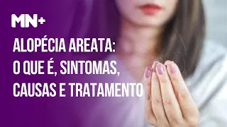 Alopécia areata: o que é, sintomas, causas e tratamento