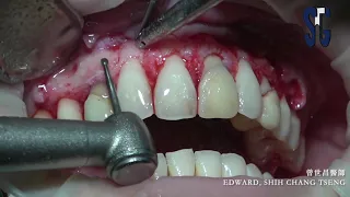 Restorative crown lengthening in esthetic zone