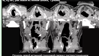 КТ диагностика рака шеи, часть 6, гортань