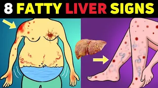 A Silent Threat: 8 Signs That Could Indicate Fatty Liver Disease