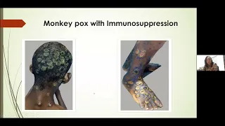 Global Dermatology Talks- 6-20-22 Special Panel on Monkeypox