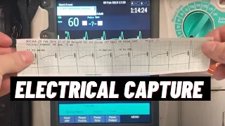 How to confirm Electrical Capture with Transcutaneous Pacing TCP on Philips HeartStart MRx?