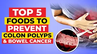 Top 5 Diabetes-Friendly Foods To Prevent Bowel Cancer and Colon Polyps