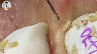 nose removal blackheads EP.13