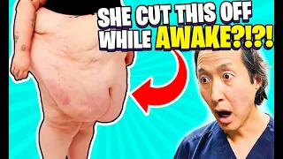 Plastic Surgeon Reacts to Getting Rid of 20 Lb Tummy While AWAKE!