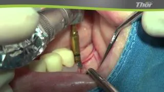 AnyRidge Ridge split surgery 4   utilizing Thor piezo machine