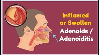 Inflamed or Swollen Adenoids / Adenoiditis