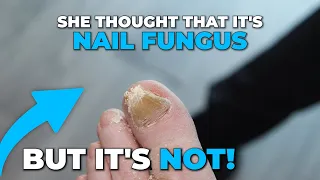 IF IT'S NOT A NAIL FUNGUS THEN WHAT IS IT?!