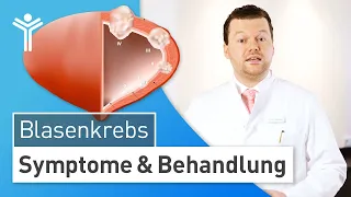 Blasenkrebs erkennen & behandeln: So gefährlich ist ein Blasenkarzinom wirklich