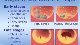 Acute Coronary Syndrome (ACS) - How it Happens