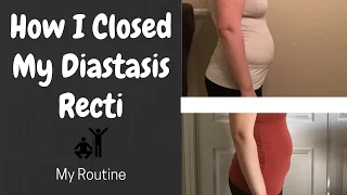 How I Closed My Diastasis Recti | My Routine
