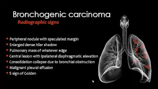 Imaging of Lung cancer   Prof Dr  Mamdouh Mahfouz In Arabic