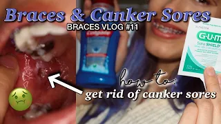MY BRACES GAVE ME A CANKER SORE | mandydel braces vlog