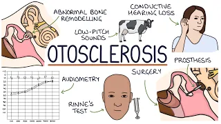 Understanding Otosclerosis