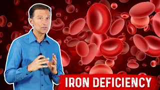 Iron Deficiency – Functions, Symptoms, & Causes Explained By Dr. Berg