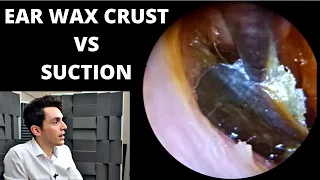 Encrusted Ear Wax VS Suction