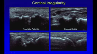 Ultrasound of Arthritis Gout, Psoriatic, Degenerative, Seronegative