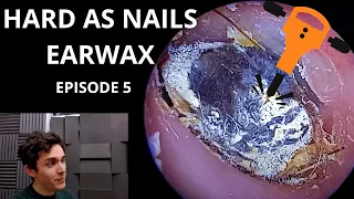 Hard As Nails Ear Wax EPISODE 5