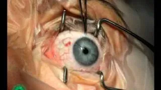 Strabismus Surgery, forced duction tests, p 2/56