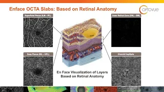 How to Utilize OCT Angiography to Detect and Manage Diabetic Retinopathy