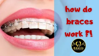 HOW BRACES WORD - Elements of the orthodontic treatment and its role