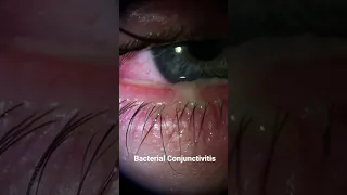 Bacterial Conjunctivitis