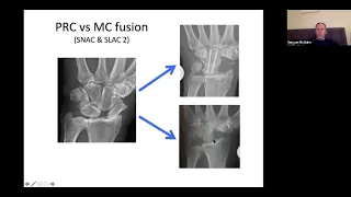 Duncan McGuire- Arthritis of the wrist & hand