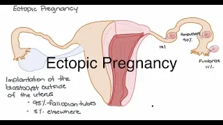 Ectopic Pregnancy