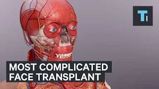 Most complicated face transplant