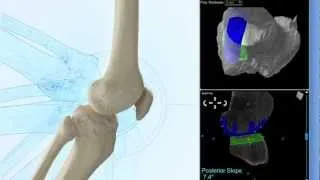Eduational Video on Robotic Knee Resurfacing (MAKOplasty)