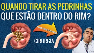 MICROCÁLCULOS RENAIS: quando fazer a cirurgia para retirar essas pedrinhas?