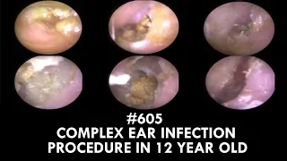 605 - Complex Ear Infection Procedure in 12 Year Old