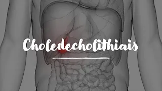 Choledecholithiasis for USMLE Step 1 & USMLE Step 2 Review (3/3)