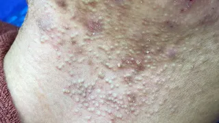 Acne Treatment For "Hung" (P11) | Điều Trị Mụn Cho Hùng (P11) - SacDepSpa#207