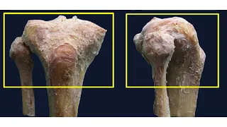 Tibial Plateau Column Concept