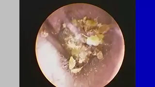 Ear wax Removal revealing Eardrum with view Ep01